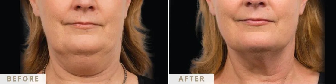 Submental contouring — before and after, consent-cleared