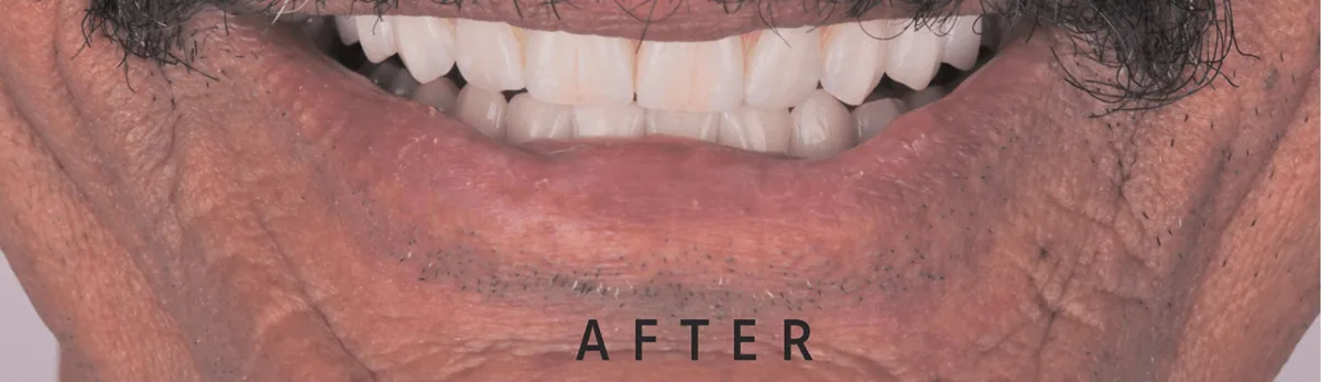 After — implant case 01