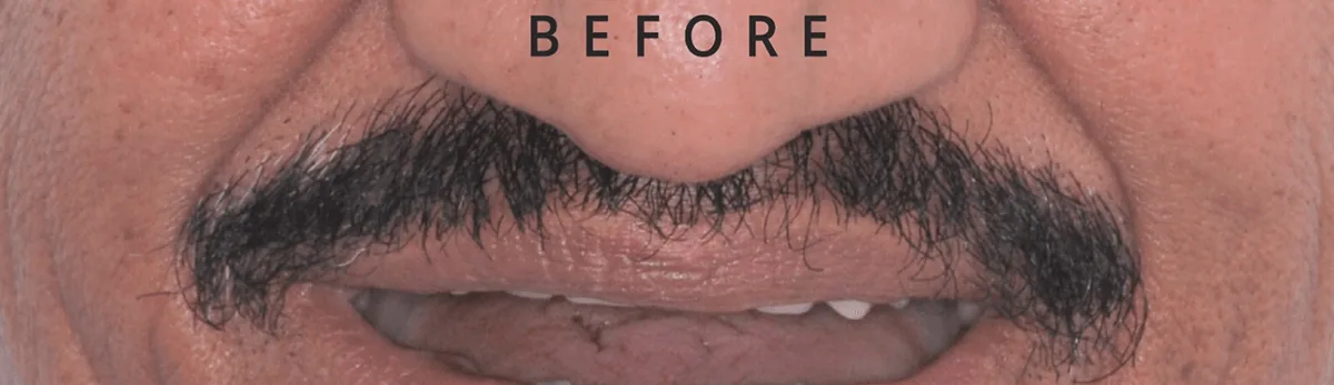 Before — implant case 01