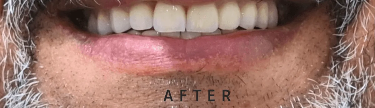 After — implant case 02
