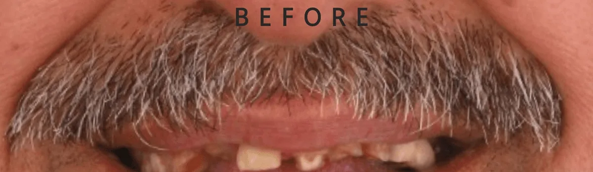 Before — implant case 02
