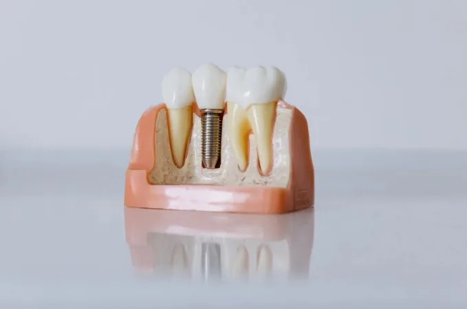 Dental implants