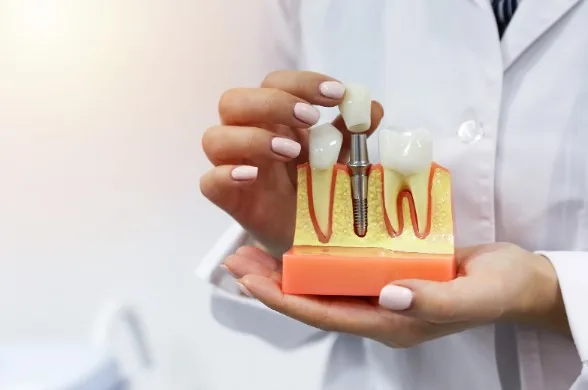 Dental implant model