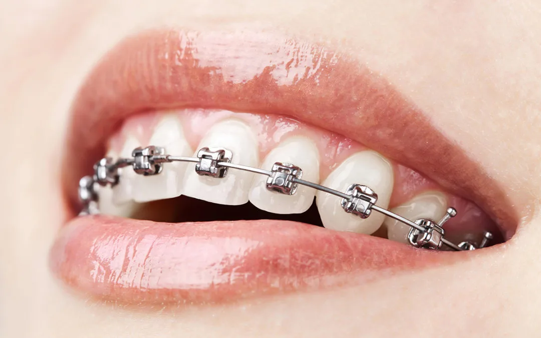 Orthodontics — braces and aligners