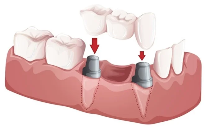 Crowns and bridges — prosthodontics