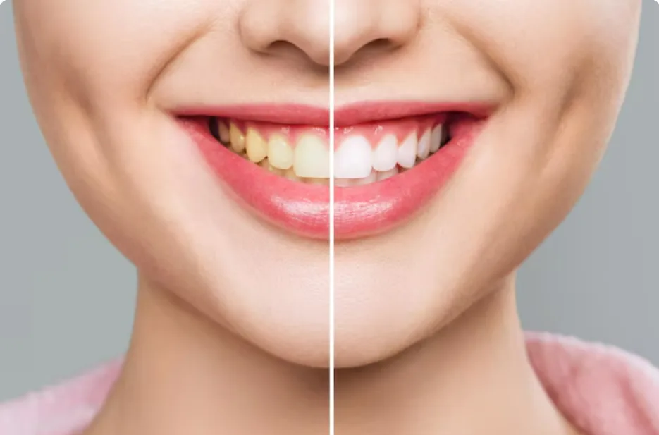 Professional teeth whitening