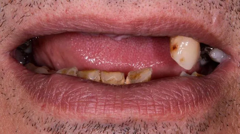 Dental implant case — before treatment