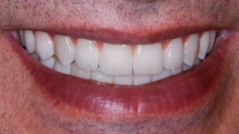 Dental implant case — after treatment