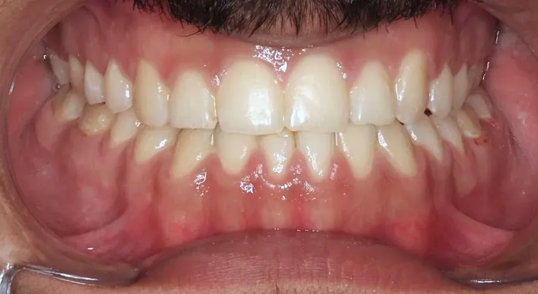 Smile after orthodontic treatment