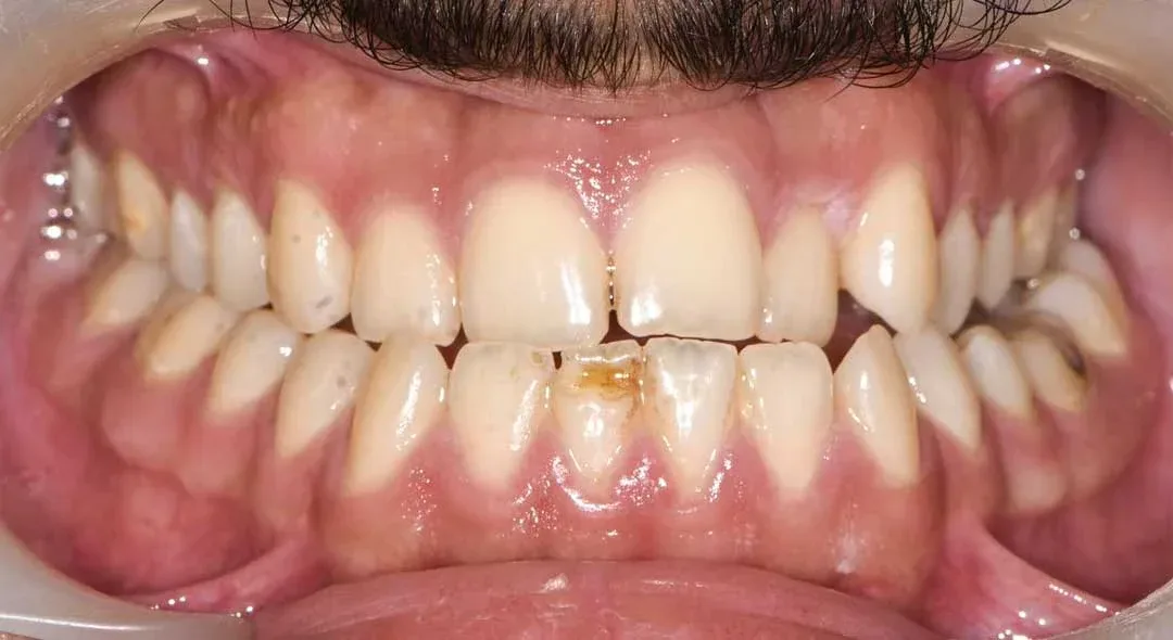 Smile before orthodontic treatment