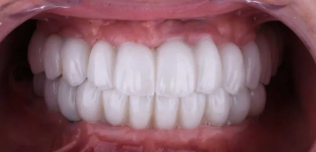 Smile after full-mouth rehabilitation