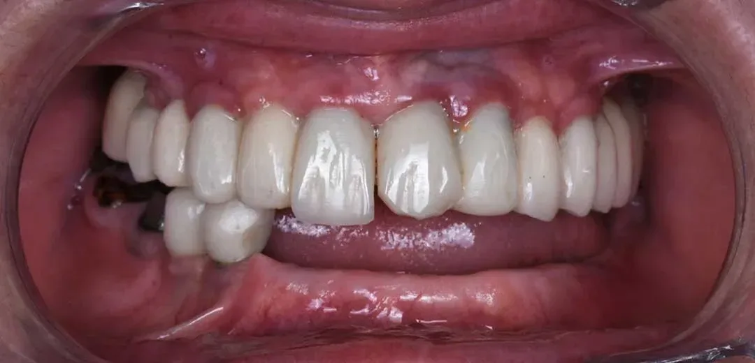 Smile before full-mouth rehabilitation