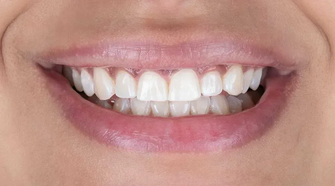 Smile after whitening