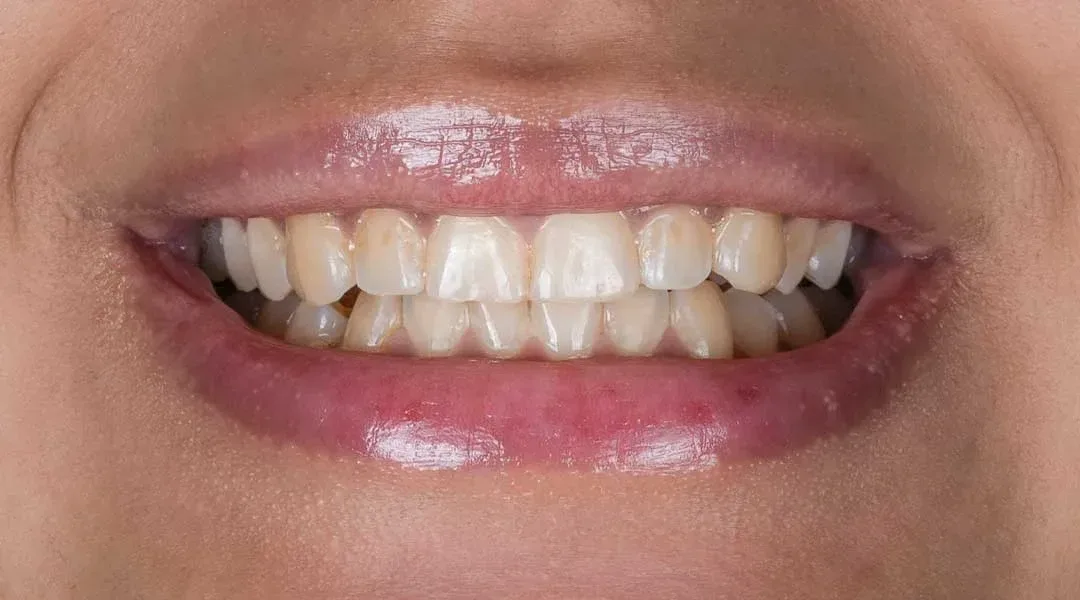 Smile before whitening