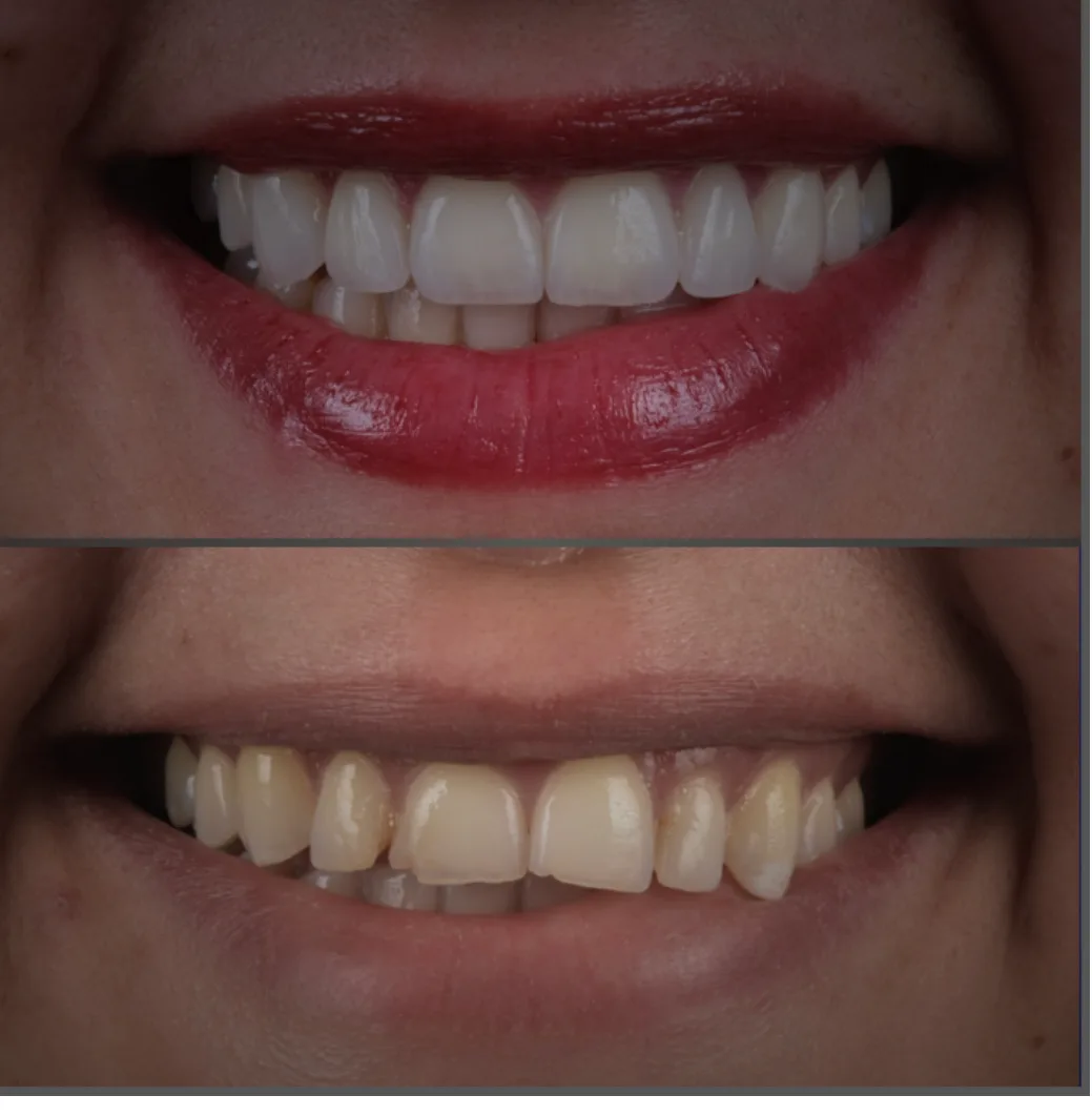 Before and after comparison of a patient's teeth