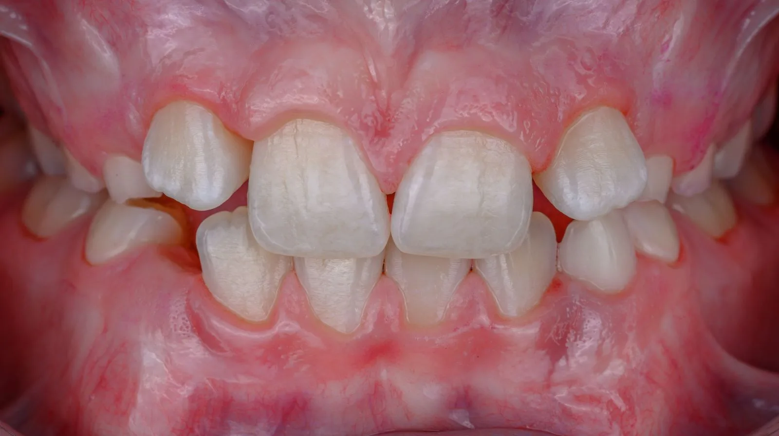 Close-up of crowded, uneven teeth before treatment
