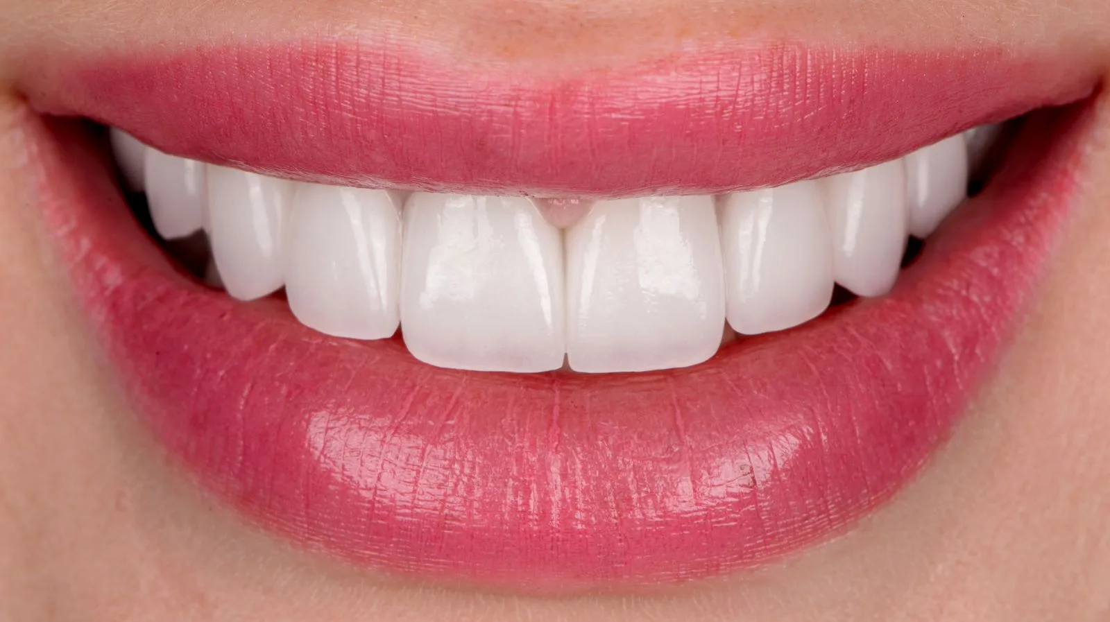 Close-up of a bright, even smile after cosmetic treatment